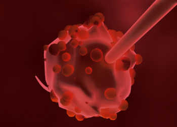 Blutkrebs, besser und richtiger als Leukämie bezeichnet, ist eine Erkrankung des blutbildenden und lymphatischen Systems. © Tsvetkov Maxim / shutterstock.com