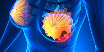 An Brustkrebs sterben mehr Frauen als an irgendeiner anderen Tumorerkrankung, mehr als 1 Million pro Jahr. © decade3d anatomy-online / shutterstock.com