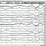 EEG zu Epilepsie im Alter