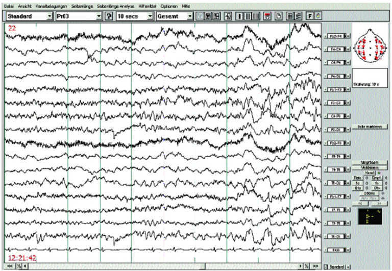 Welche Krankheiten Kann Man Mit Eeg Feststellen