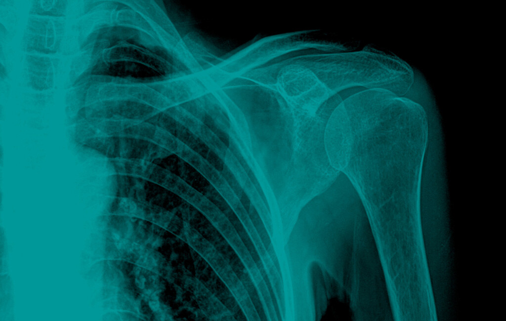 Osteoporotische Knochenbrüche gehören bei Frauen ab 50 Jahre zu den häufigsten Leiden. © thailoei92 / shutterstock.com