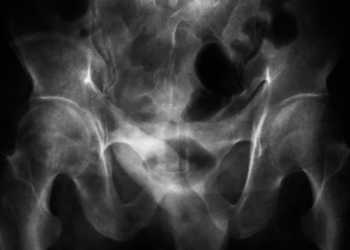 Männer und Osteoporose ist der Grund für viele Knochenbrüche ab dem 50. Lebensjahr. © Chaikom / shutterstock.com