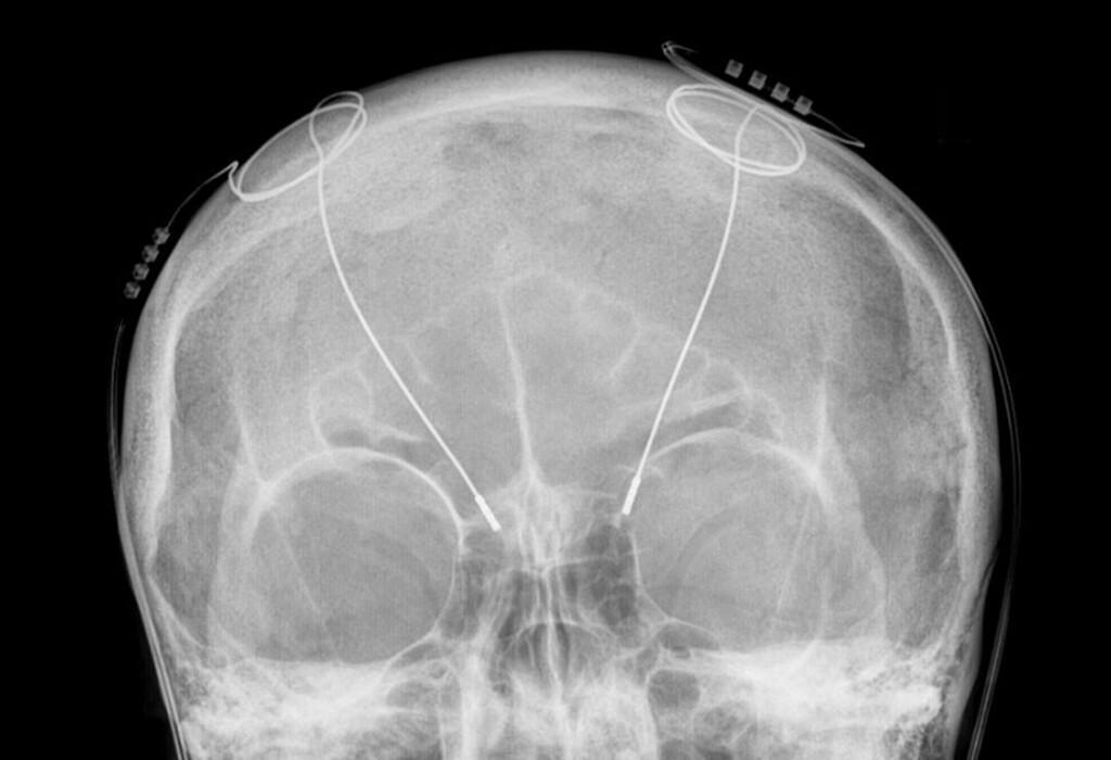 Tiefe Hirnstimulation Hirnschrittmacher Bei Morbus Parkinson