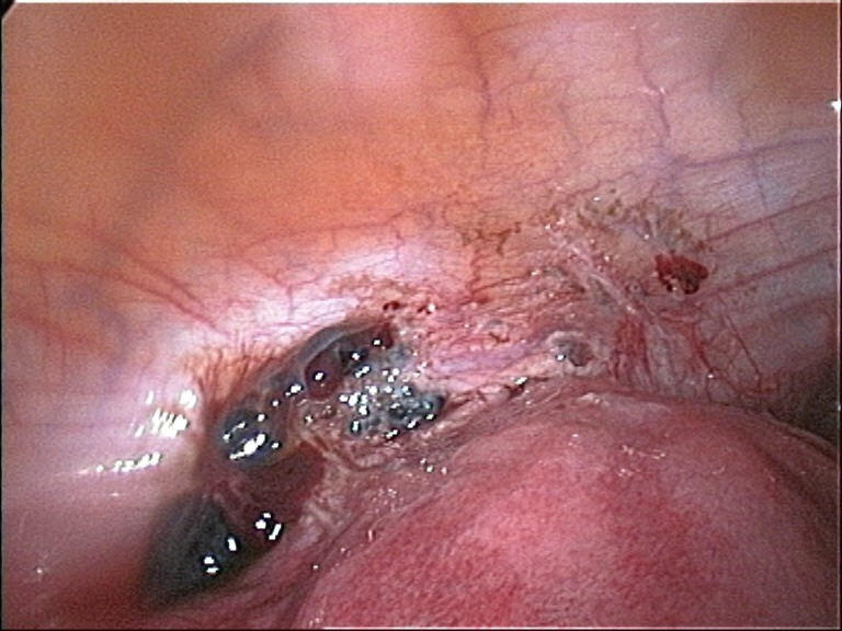Schwangerschaft und Endometriose höheres Risiko für Komplikationen