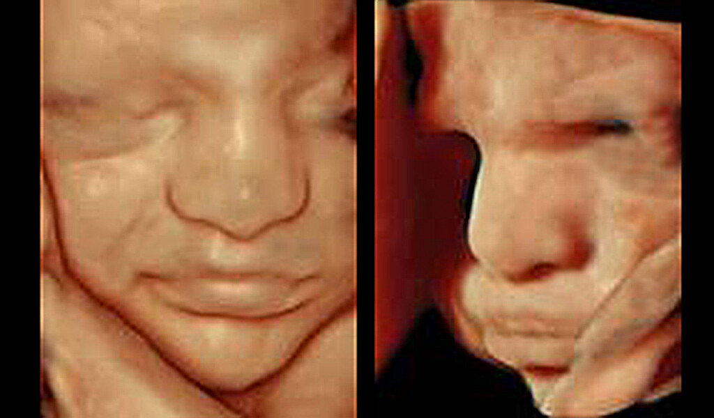 Fetus im Ultraschall mit 31 Schwangerschaftswochen: Erst lächelt das Ungeborene etwas, wenige Minuten später zeigt es ein missmutiges Gesicht. © Prof. E. Merz