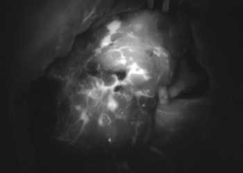 Ein gutes Beispiel für Supermikrochirurgie: Ansicht eines Lymphknotenpakets unter dem Fluoreszenzmikroskop. Der leuchtende Bereich zeigt Gefässe, die nach dem mikrochirurgischen Anschluss wieder durchblutet sind. © USZ