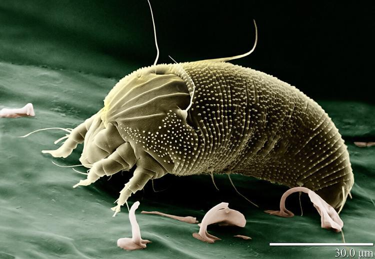 Krätze – Scabies: die häufige Infektion der Haut ist weiter am Vormarsch