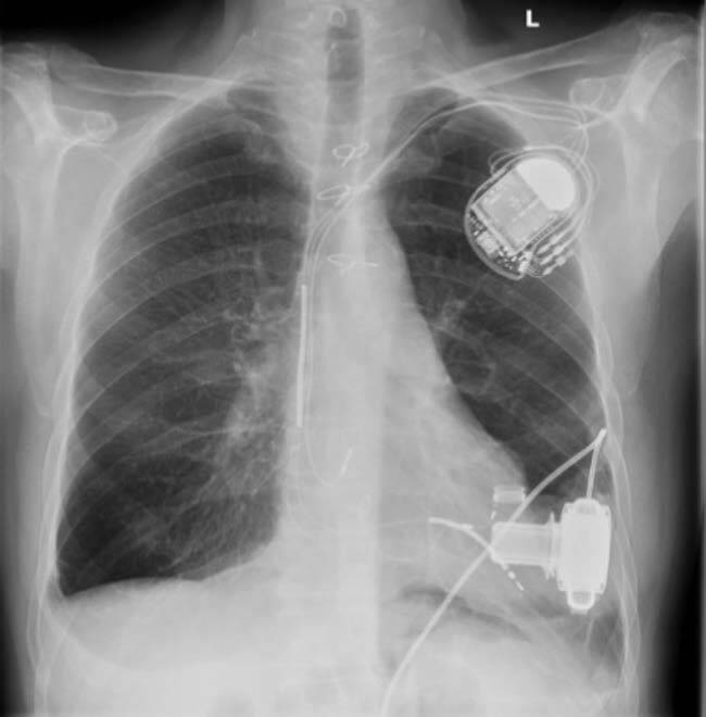 Röntgen-Thoraxaufnahme eines Patienten mit Herzschrittmacher und LVAD (Heartware). © DGKN/Siebler M, Marx R. Klinische Neurophysiologie 2015 (Thieme); 46