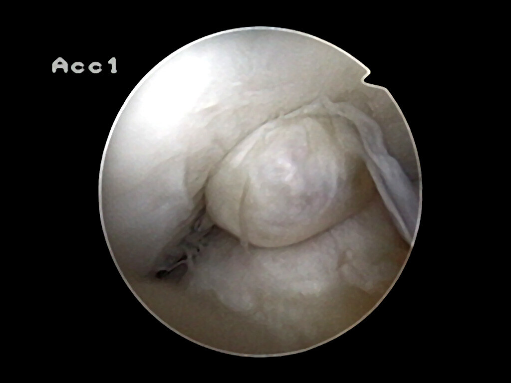 Arthroskopische Aufnahme eines Zyklops im Knie eines Patienten, ein Zyklops ist eine sekundäre Arthrofibrose. © Prof. Dr. Norbert M. Meenen / Common Creative BY-SA 3.0