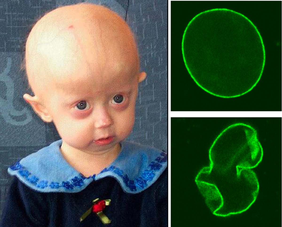 An Progerie Erkrankte leiden am sogenannten Hutchinson Gilford Progerie Syndrom. © The Cell Nucleus and Aging: Tantalizing Clues and Hopeful Promises. Scaffidi P, Gordon L, Misteli T. PLoS Biology Vol. 3/11/2005, e395 doi:10.1371/journal.pbio.0030395 / Creative Commons CC 2.5