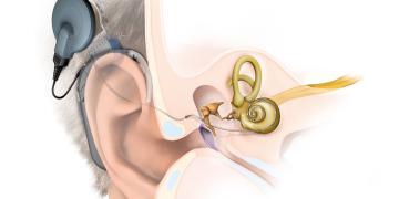 Hörimplante nutzen mittlerweile zahlreichen Patienten – im Bild ein CochleaImplantat. © MED EL Elektromedizinische Geraete GmbH