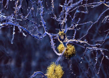 Eingeschleuste Immunzellen konnten die Bildung von Alzheimer-Plaques, die in der Grafik gut erkennbar sind, nicht rückgängig machen. © Juan Gaertner / shutterstock.com