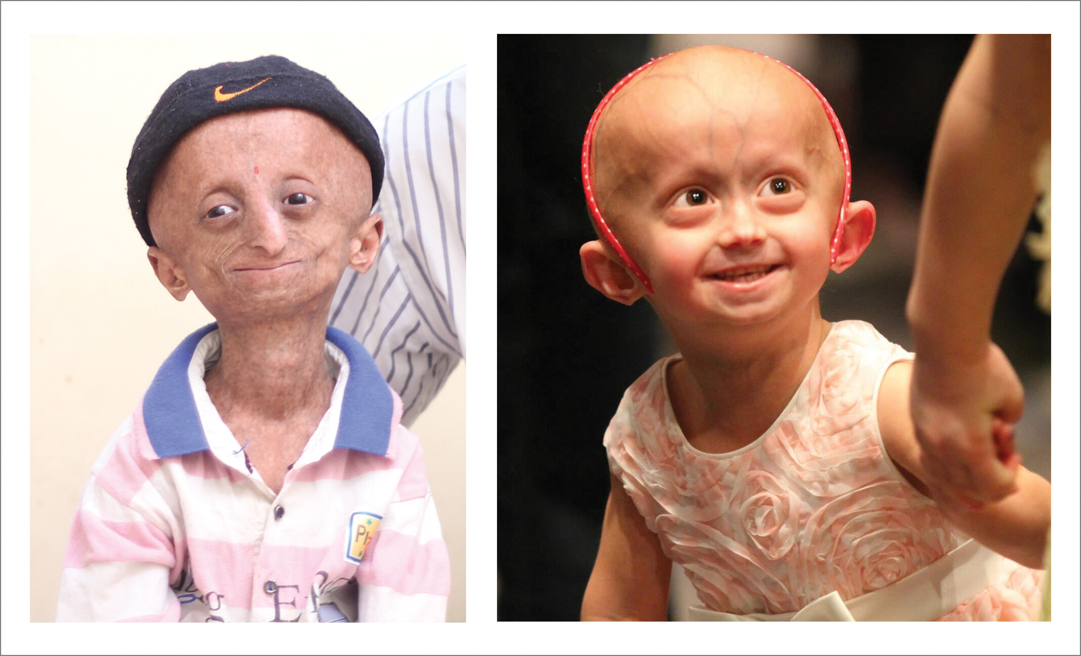 Progeria porn