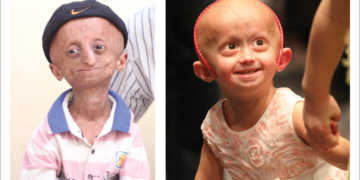 Progerie ist der Fachbegriff für eine Erkrankung, die Kinder zehnmal schneller altern lässt. © PRF