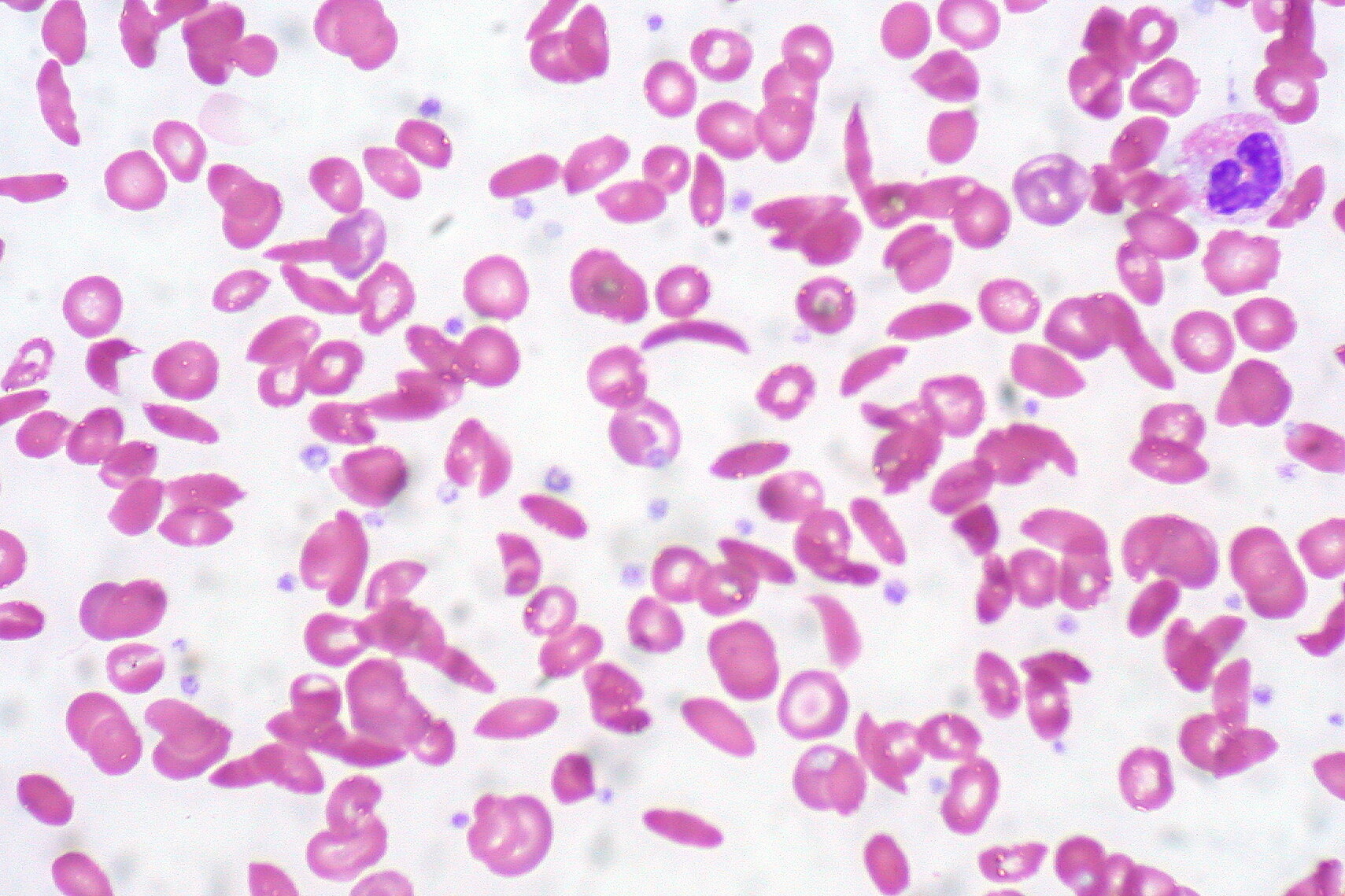 Die Sichelzellanämie ist Folge einer erblich bedingten Veränderung des roten Blutfarbstoffs Hämoglobin in den roten Blutzellen. © Ed Uthmann