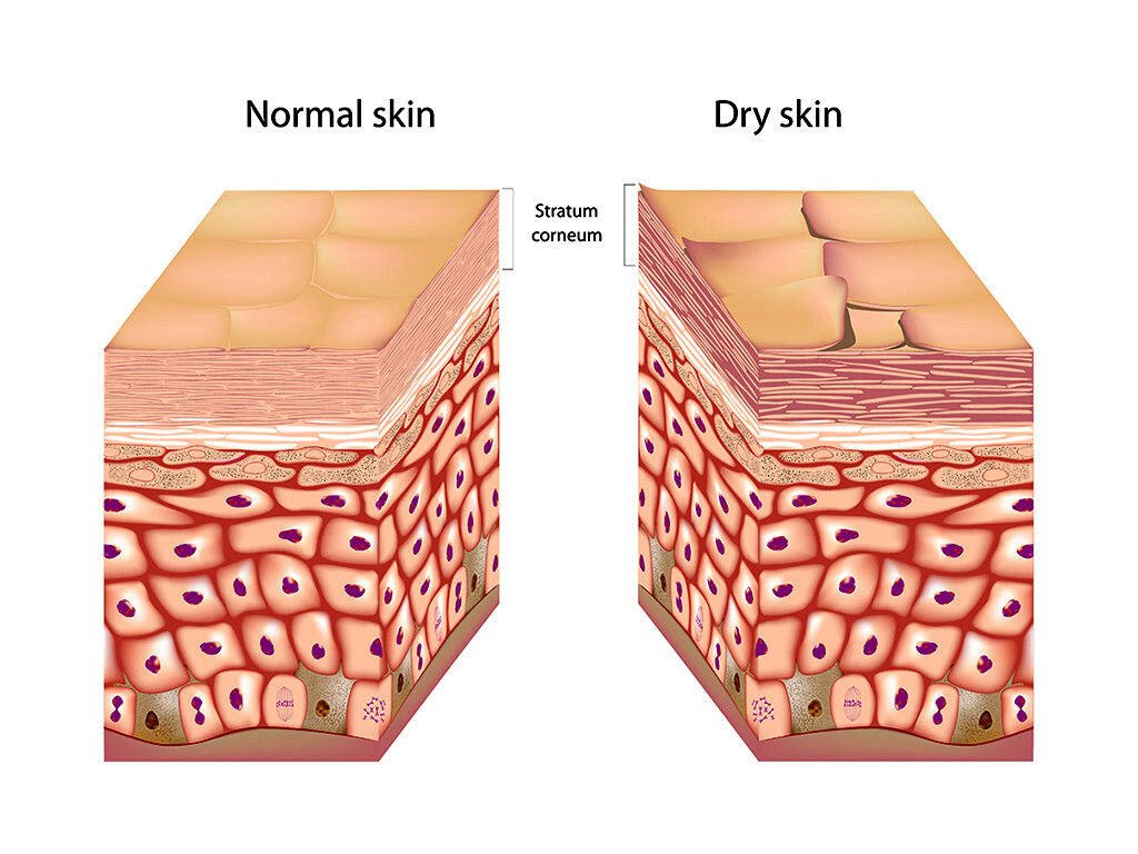 Trockene Haut (Sebostase) geht mit einem Fehlen körpereigene Lipide einher, welche bei gesunder Haut die Feuchtigkeit binden und einen Schutzschild gegen Umwelteinflüsse aufbauen. © Alila Medical Media / shutterstock.com