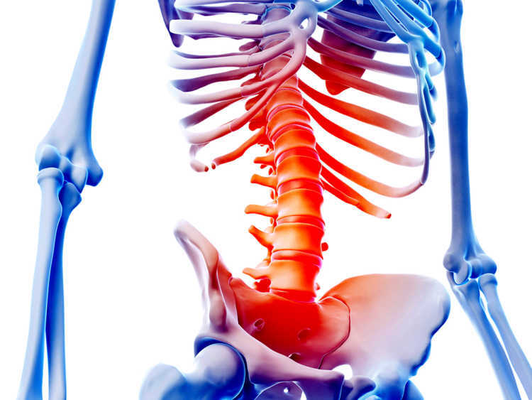 Morbus Bechterew Rückenschmerzen Spondylitis ankylosans
