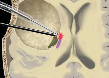 Illustration: Die Hybridsonde (schwarz) zeigt dem Chirurgen während der Operation via akustisches Signal, wie nah sich dieser an einer motorischen Bahn im Gehirn befindet (lila). © Universitätsklinik für Neurochirurgie, Inselspital, Universitätsspital Bern