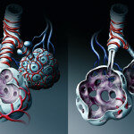 COPD-allgemein