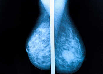 Während in Österreich Ultraschall nach Mammographie nicht selten vorkommt, mangelt es in Deutschland an Information und Beratung. © Photoprofi30 / shutterstock.com
