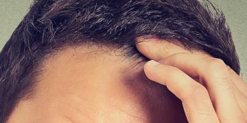 In den letzten Jahren hat sich gezeigt, dass bei immer mehr jungen Männern androgenetischer Haarausfall vorkommt. © PathDoc / shutterstock.com
