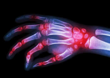 Die rheumatoide Arthritis ist die häufigste entzündliche Gelenkserkrankung. © Puwadol Jaturawutthichai / shutterstock.com