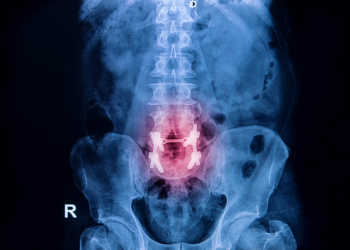 Da vor allem ältere Patienten an Osteoporose-Schmerzen leiden, ist der Einsatz von NSAR aufgrund der Risiken und Nebenwirkungen problematisch. © Praisaeng / shutterstock.com