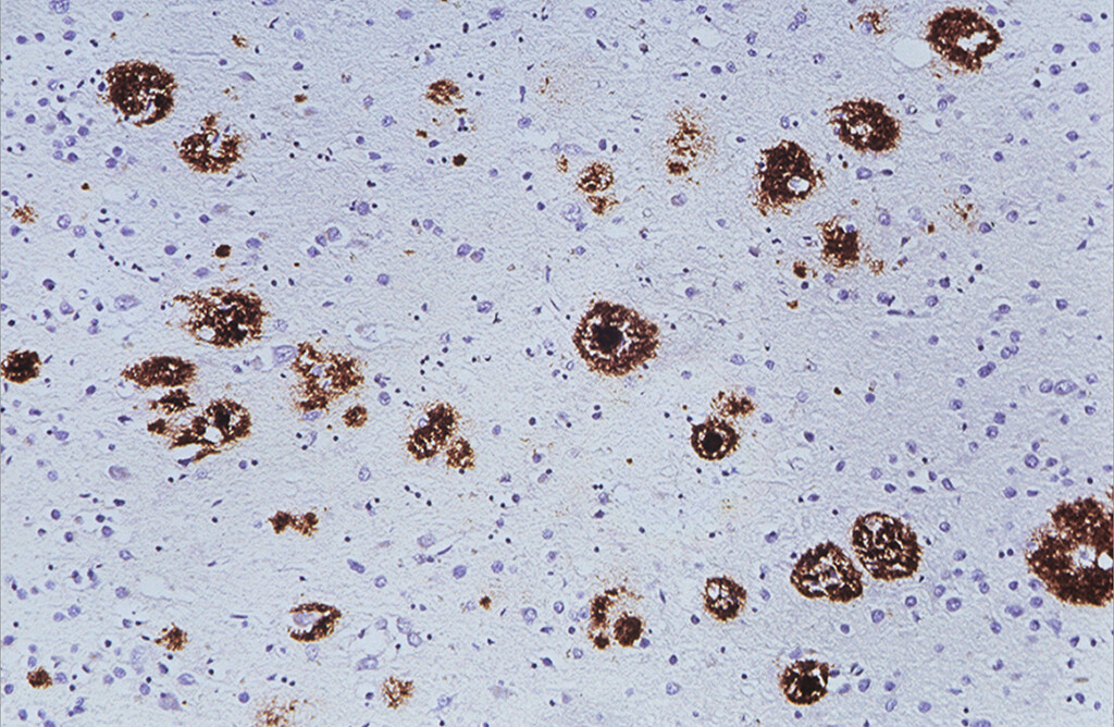 Braun gefärbte Aβ-Plaques in der Hirnrinde bei Alzheimer-Krankheit. © Universitätsspital Zürich