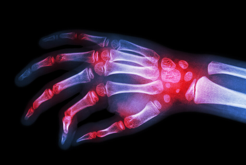 Rheumatoide Arthritis im Fokus von Experten Rudolf Puchner. © Puwadol Jaturawutthichai / shutterstock.com