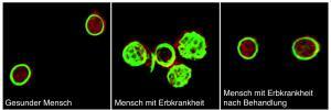 Gesunde Blutplättchen besitzen organisiertes Aktin-Zellskelett (rot), umgeben von Mikrotubuli (grün). Bei Patienten mit TRPM7 Kanal Defekt ist dies geschädigt,kann aber mit Mg2+ normalisert werden. Arbeitsgruppe Nieswandt / Rudolf-Virchow-Zentrum