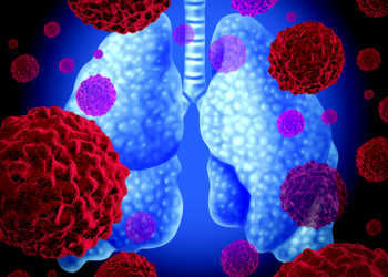 Das Lungenkarzinom zählt zu den häufigsten Krebsarten. © Lightspring / shutterstock.com