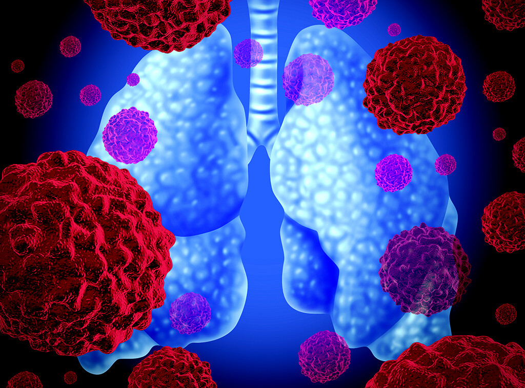 Das Lungenkarzinom zählt zu den häufigsten Krebsarten. © Lightspring / shutterstock.com