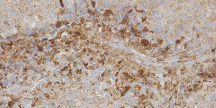 Ewing Sarkom in einer Maus nach dem Einsatz des Hemmstoffs JQ1 (Ausschnitt): Der beginnende Zelltod der Knochentumor-Zellen ist mit braunem Farbstoff kenntlich gemacht. © Günther Richter / TUM