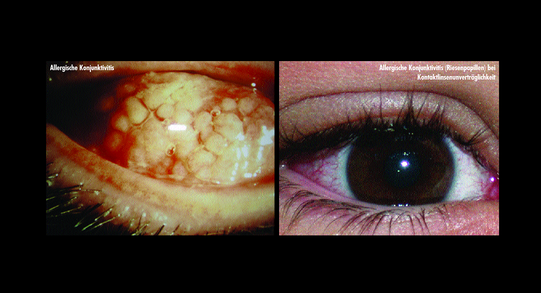 Allergische Konjunktivitis – das Auge ist bei bis zu 90 Prozent der Atopiker mitbeteiligt.