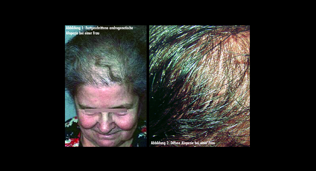 Minoxidil lässt sich bei praktisch allen Haarwachstumsstörungen einsetzen.