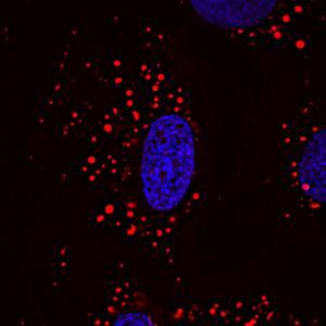 Mikroskopische Aufnahme von Herzzellen von Patienten mit BTHS: blau Zellkern, rot Mitochondrien. Zu sehen ist die defekte punktförmige Ausprägung der Mitochondrien. © umg