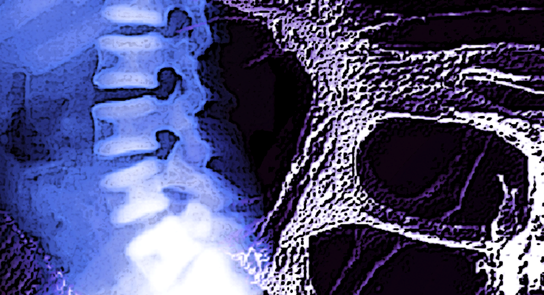 Die Knochendichtemessung ist eine schnelle Methode, um eine Osteoporose-Diagnose zu stellen.