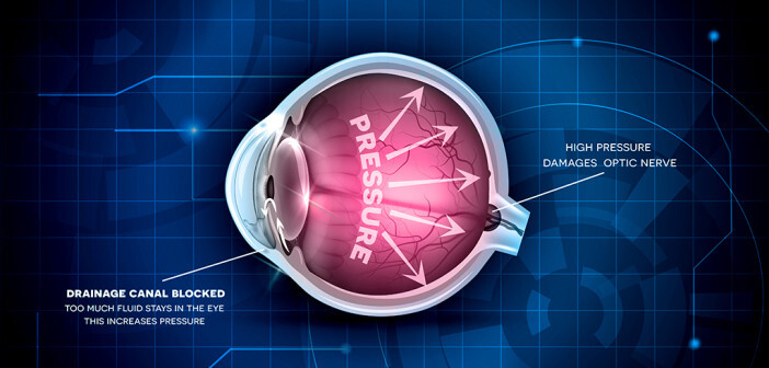 Erhöhter Augeninnendruck ist der bedeutendste Risikofaktor für ein Glaukom – der Augenerkrankung Grüner Star. © Tefi 7 shutterstock.com
