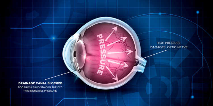 Erhöhter Augeninnendruck ist der bedeutendste Risikofaktor für ein Glaukom – der Augenerkrankung Grüner Star. © Tefi 7 shutterstock.com
