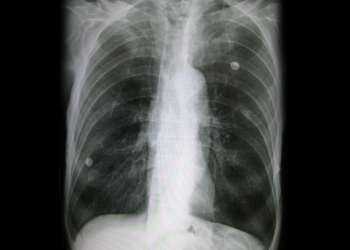 Röntgen einer Lunge mit Lungenemphysem. © James Heilman, MD / CC BY-SA 3.0 / wikimedia