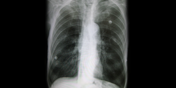 Röntgen einer Lunge mit Lungenemphysem. © James Heilman, MD / CC BY-SA 3.0 / wikimedia