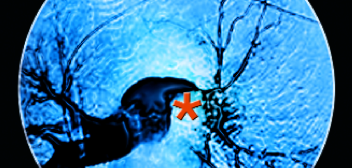 Trotz aller technischen Errungenschaften sind die ­Möglichkeiten der Diagnose bzw. des Ausschlusses ­einer Lungenembolie bis heute ­unbefriedigend.