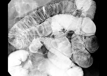 Fixierte Stenose des Dünndarms bei M. Crohn. Enteroklysma im Doppelkontrast. © Hellerhoff / shutterstock.com