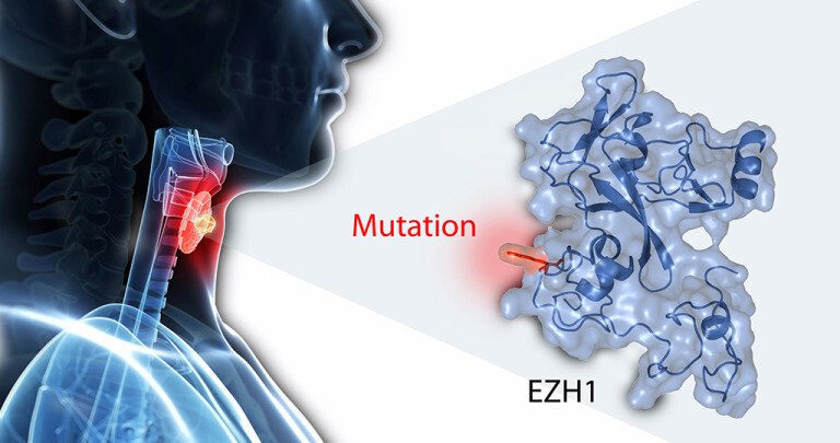 Autonome Adenome gutartiger Tumore der Schilddrüse