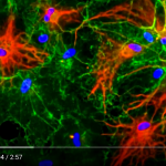 alzheimer-plaque