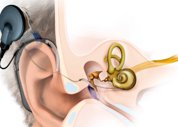 Hörimplantate wurden ursprünglich für völlig taube Patienten entwickelt. © med el elektromedizinischegeraetegmbh