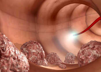 Investitionen in die Darmkrebs-Vorsorge mittels Koloskopie lohnen sich. © naeblys / shutterstock.com