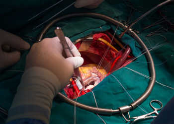 Eine Mitralklappeninsuffizienz konnte lange Zeit nur durch eine offene Herzoperation behandelt werden. © ChaNaWiT / shutterstock.com