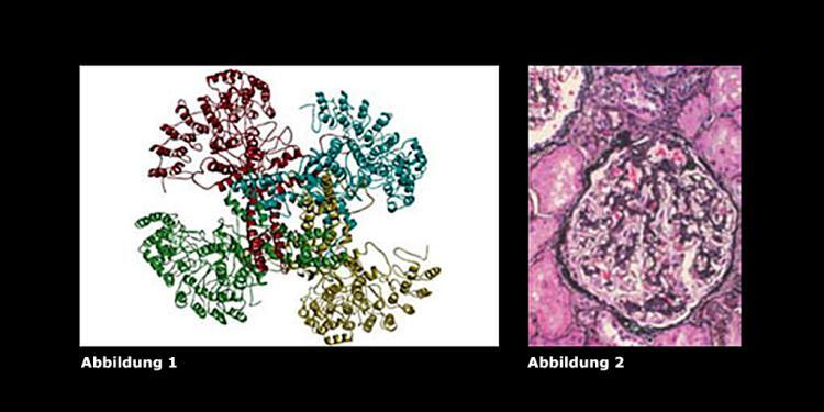 Abbildungen zu den Ursachenn für Fokal-segmentale Glomerulosklerose – Abbildungen. © Riehle et al. / JASN, 2016