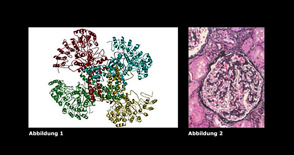 Abbildungen zu den Ursachenn für Fokal-segmentale Glomerulosklerose – Abbildungen. © Riehle et al. / JASN, 2016